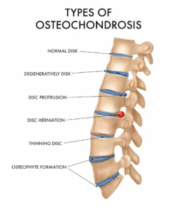 Diagram of spine with vertebrae and discs with different osteochondrosis shown