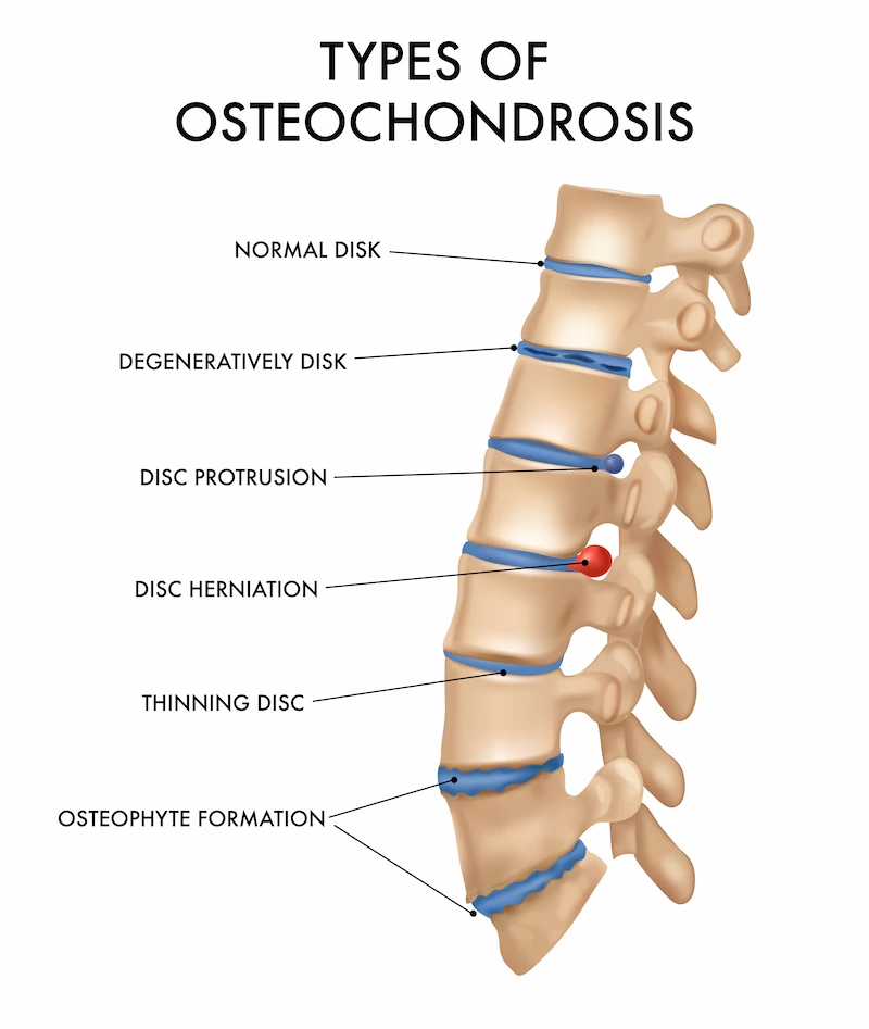 Diagram of spine with vertebrae and discs with different osteochondrosis shown